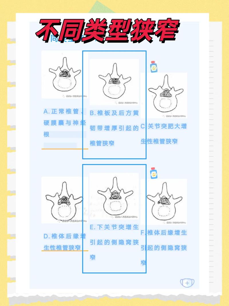 包含人类夜间身高缩减的椎间盘水分变化的词条