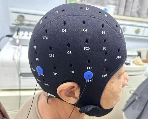 脑机接口治疗精神疾病(脑机接口治疗精神疾病需要多久)