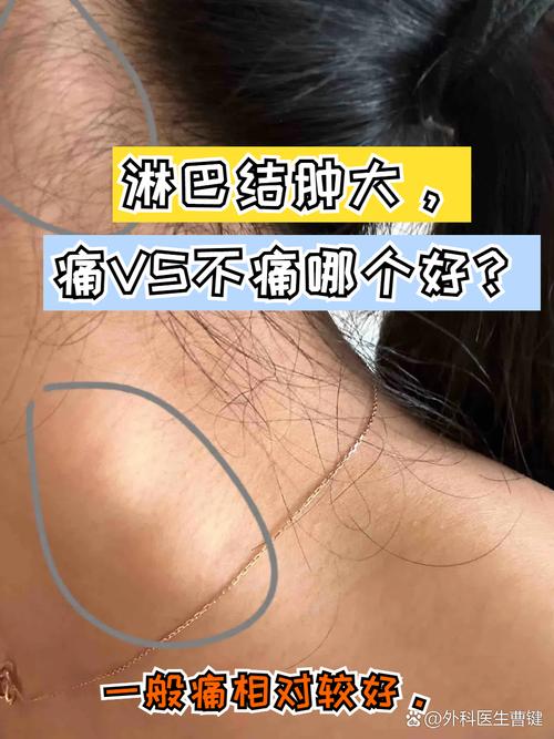 组织细胞坏死性淋巴结炎（组织细胞坏死性淋巴结炎是什么病）