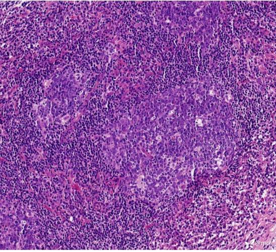 组织细胞坏死性淋巴结炎（组织细胞坏死性淋巴结炎是什么病）